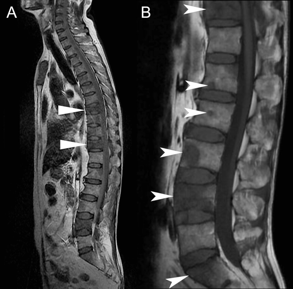 Vertebral metastasis