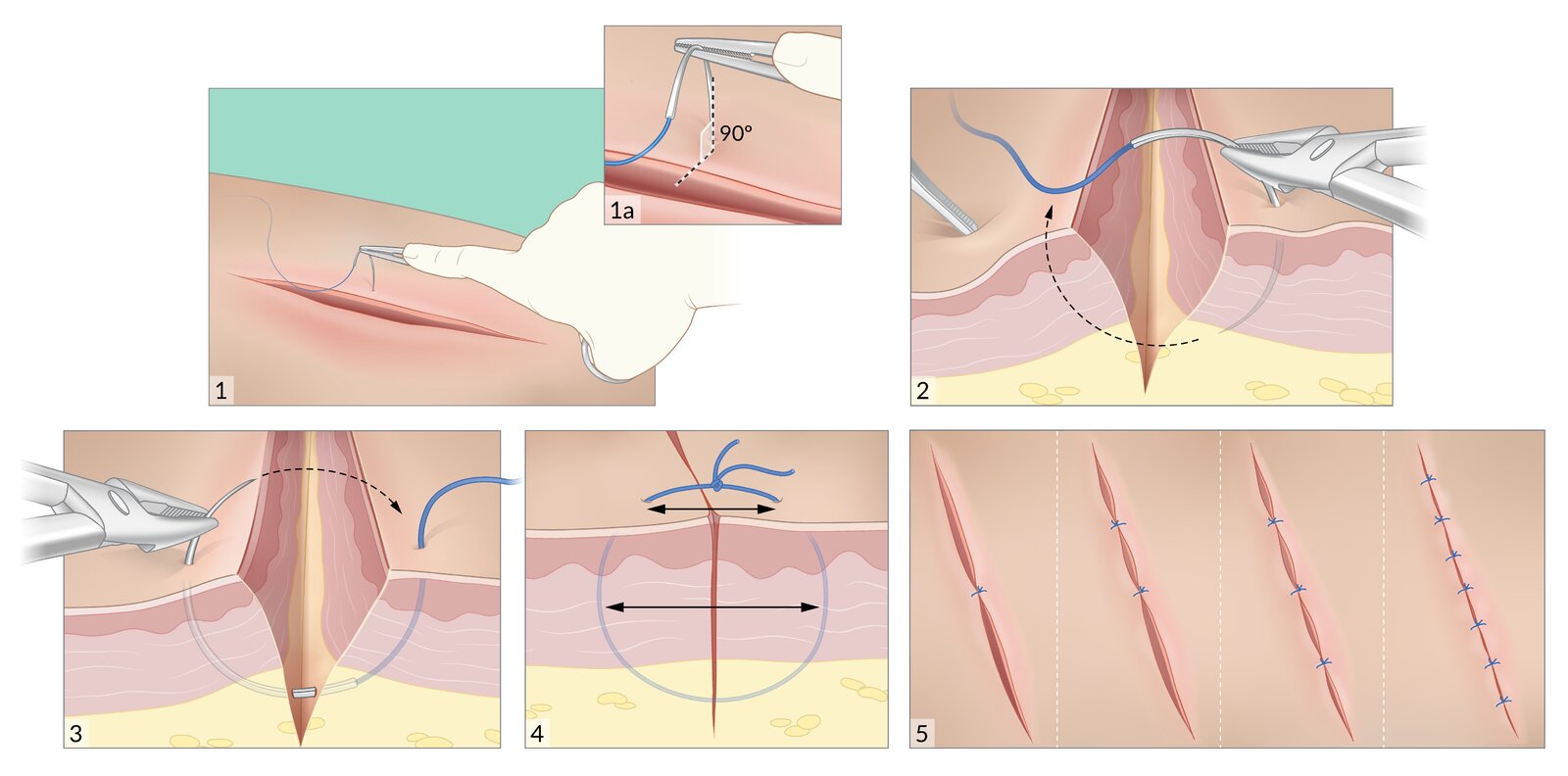 Simple interrupted suture
