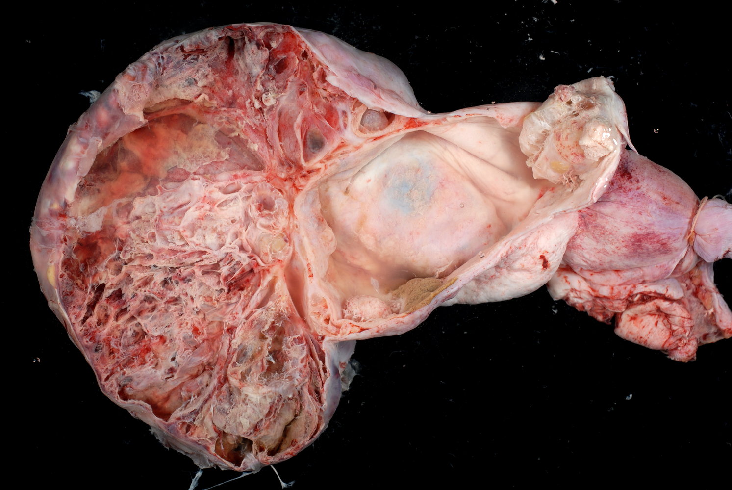 Mucinous cystic tumor of the ovary