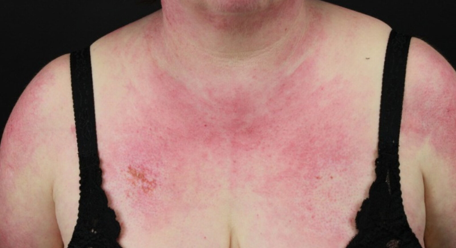 V sign of dermatomyositis