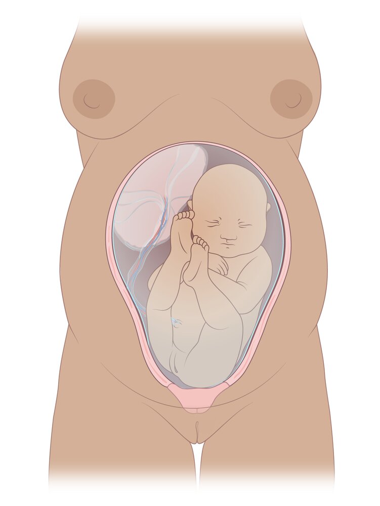 Breech presentation