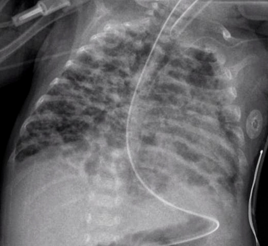 Bronchopulmonary dysplasia