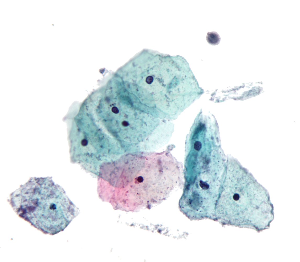 Papanicolaou test (trichomoniasis)
