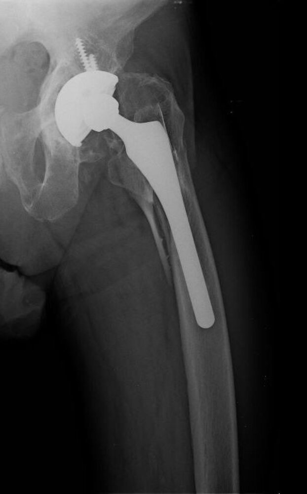 Periprosthetic femur fracture