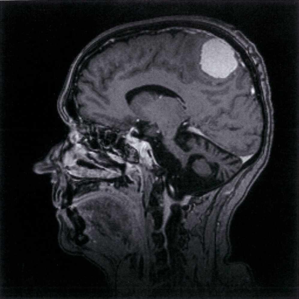Dural based mass