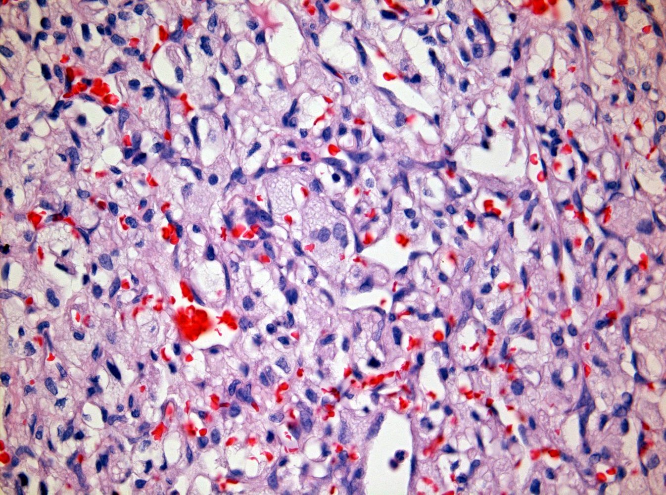 Hemangioblastoma