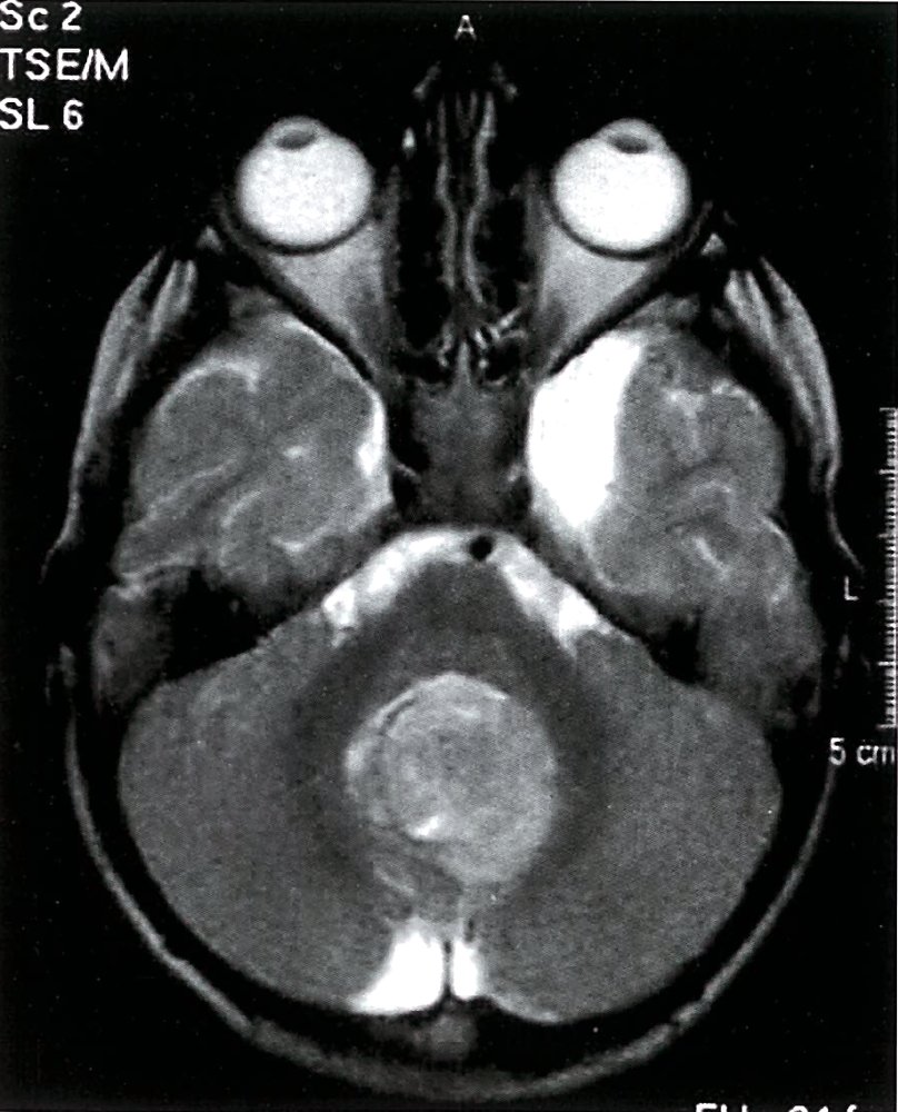 Pediatric fourth ventricular tumor
