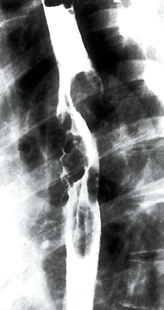 Malignant esophageal stricture