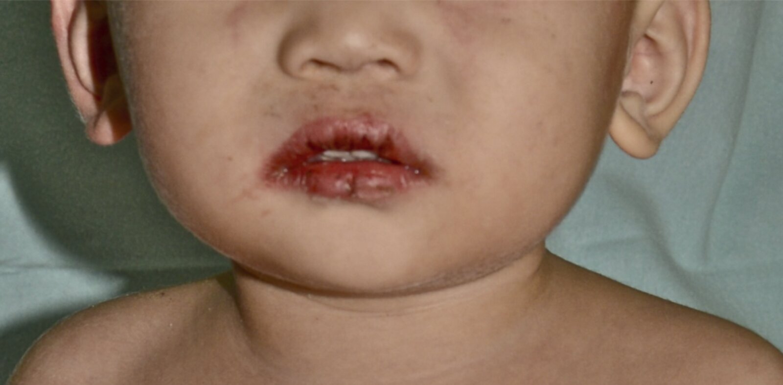 Kawasaki disease