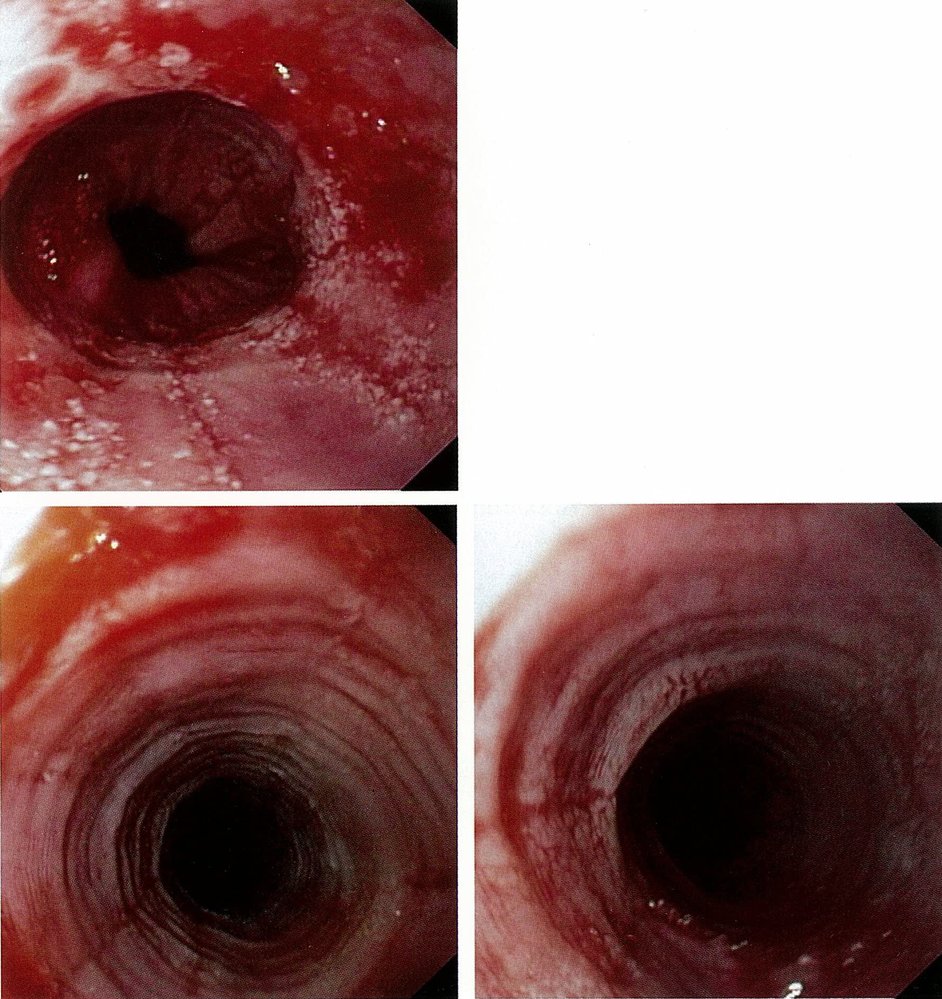 Eosinophilic esophagitis