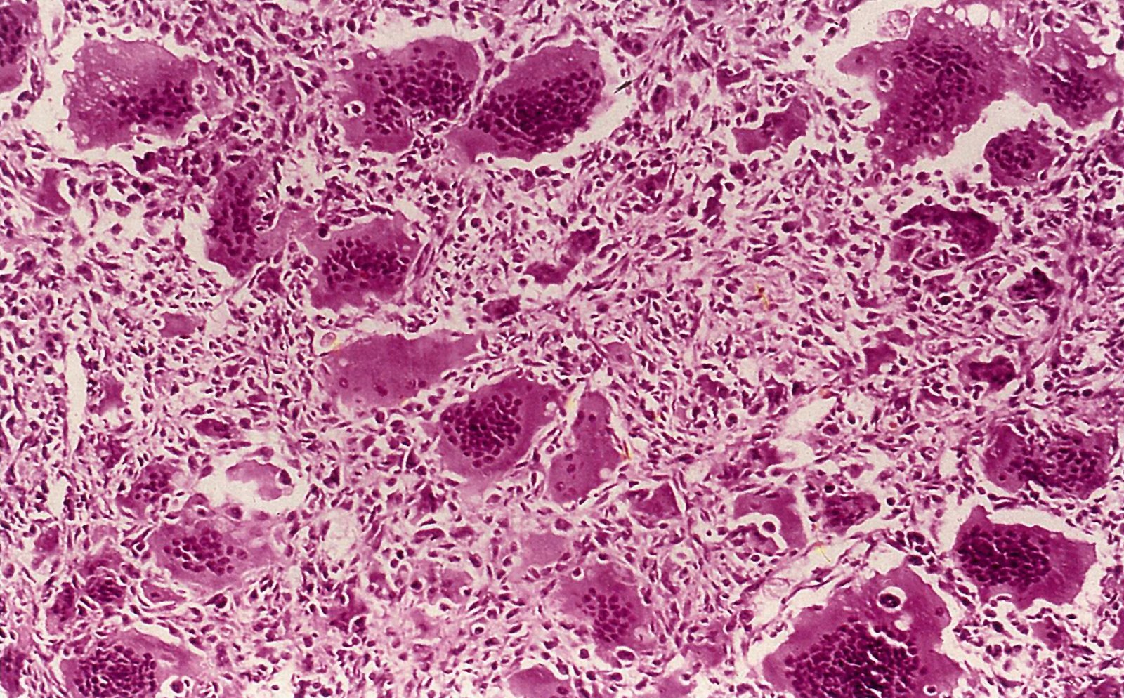 Giant-cell tumor of the bone (osteoclastoma)