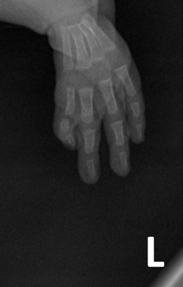 Thumb aplasia