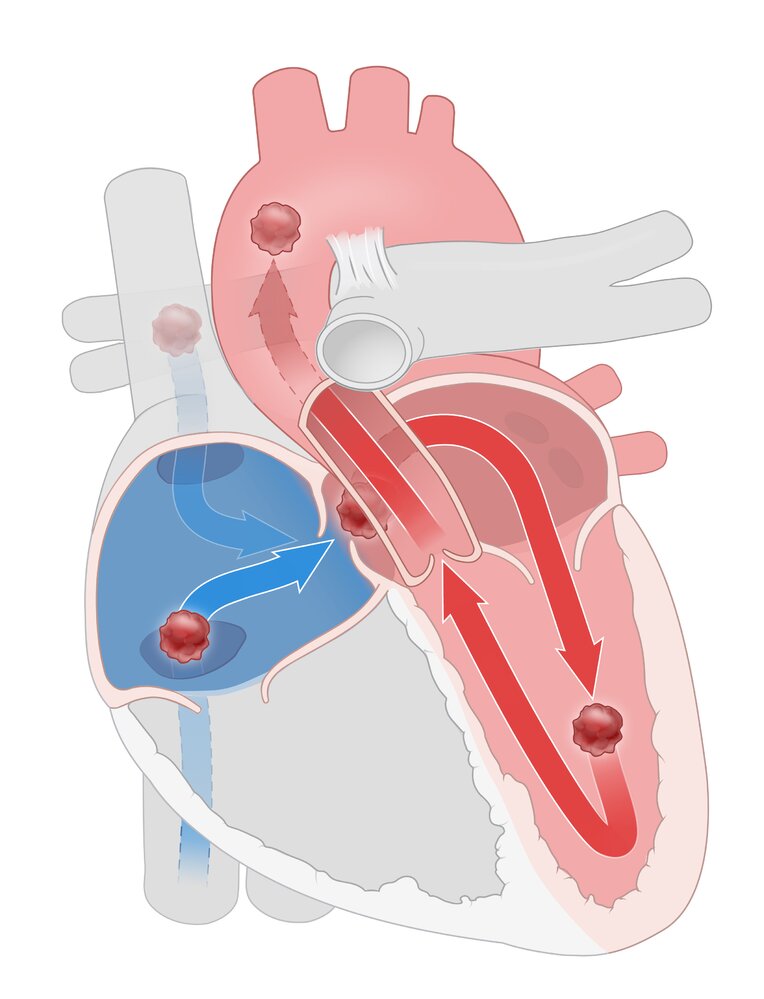 Pathophysiology of paradoxical embolism