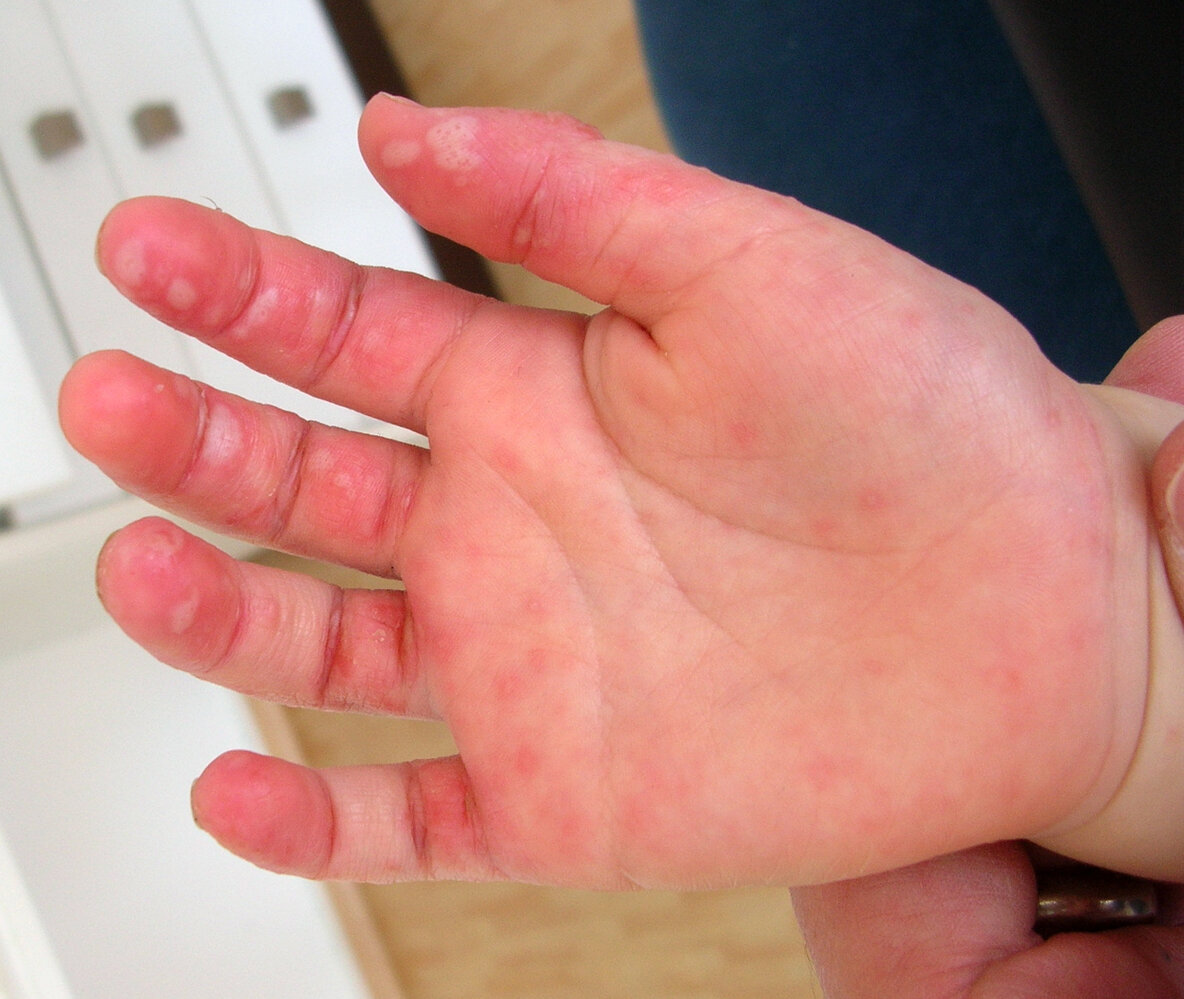 Hand foot and mouth disease