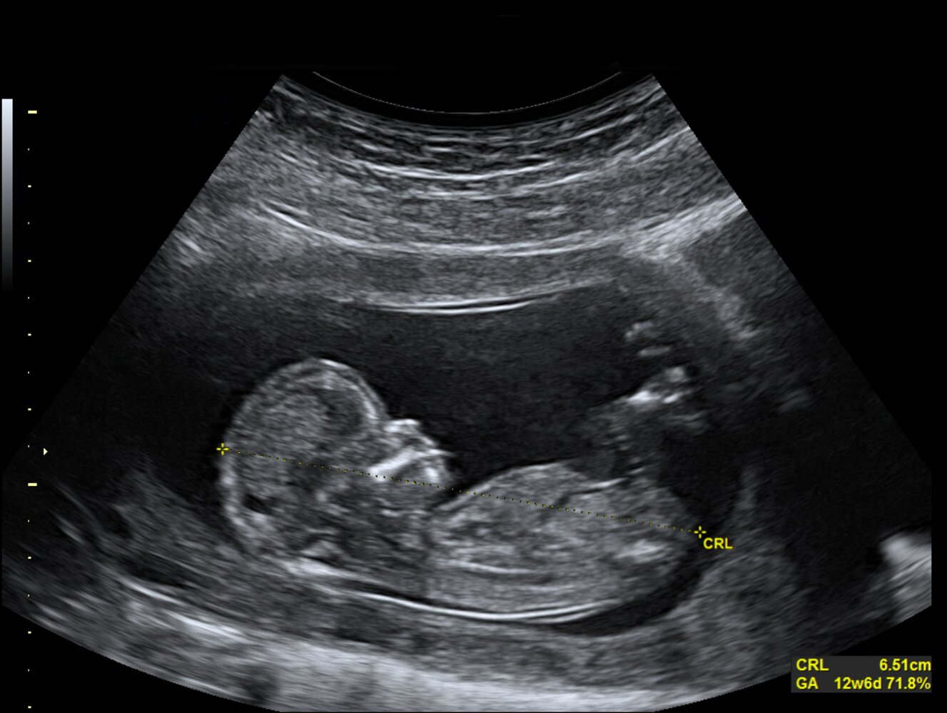 Ultrasound measurement of crown-rump length