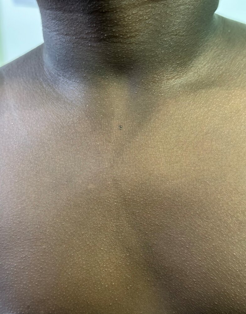 Scarlet fever rash