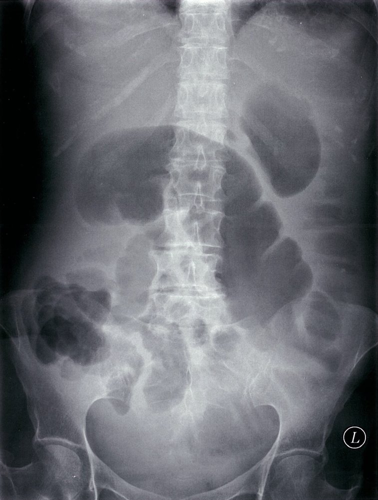 Dilated colon