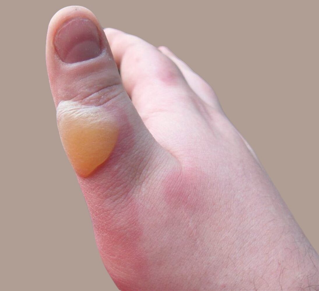Superficial partial-thickness burn