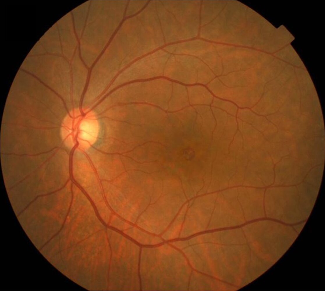 Macular hole