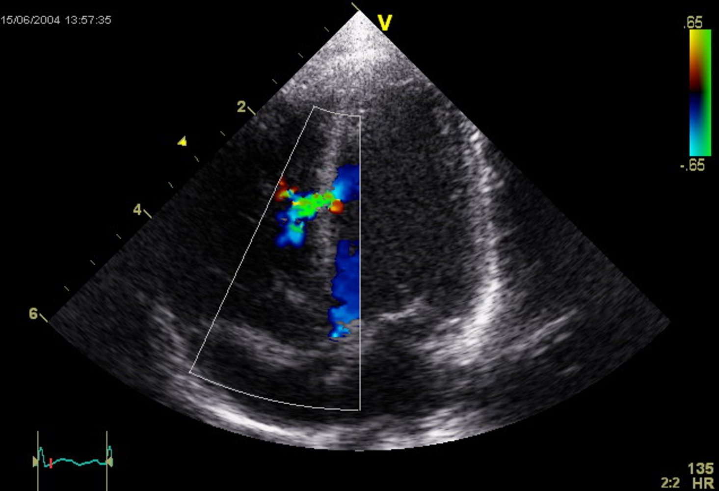 Ventricular septal defect