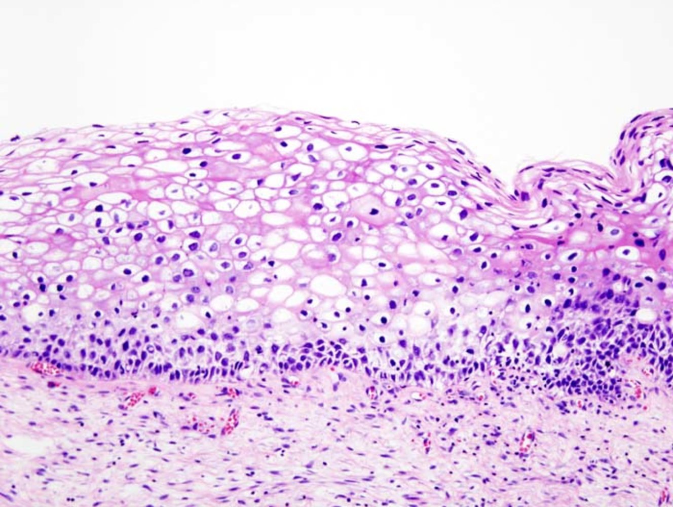 Cervical intraepithelial neoplasia (CIN2)