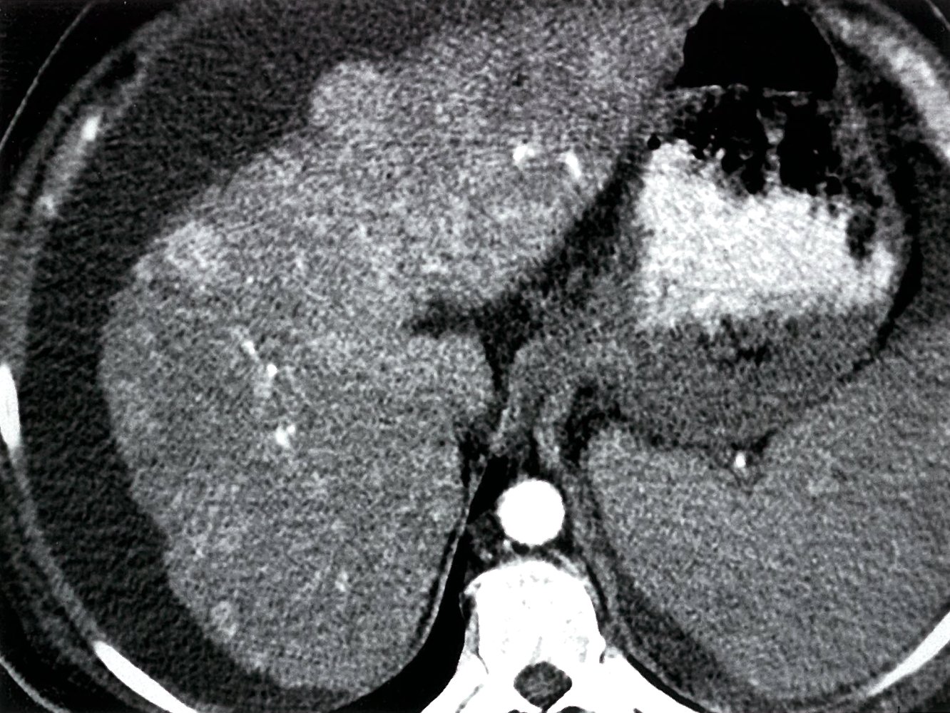 Multiple liver masses in cirrhosis