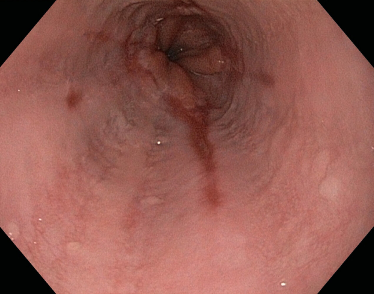 Erosive esophagitis