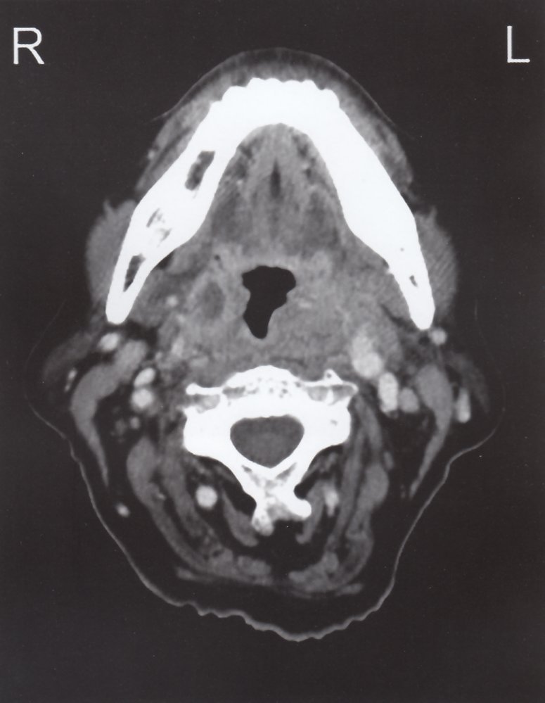 Parapharyngeal inflammation with abscess