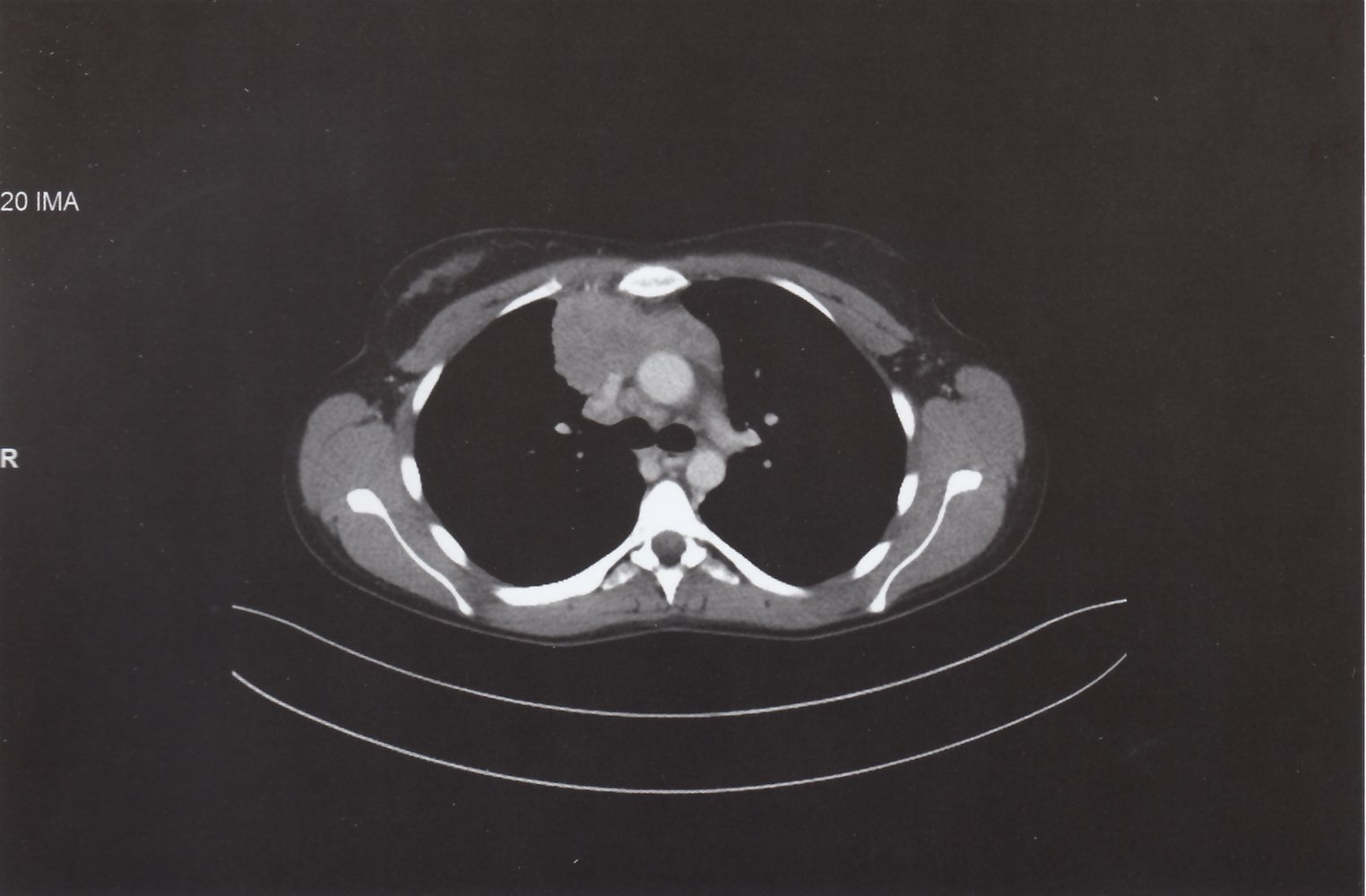 Anterior mediastinal mass in Hodgkin lymphoma 1/2