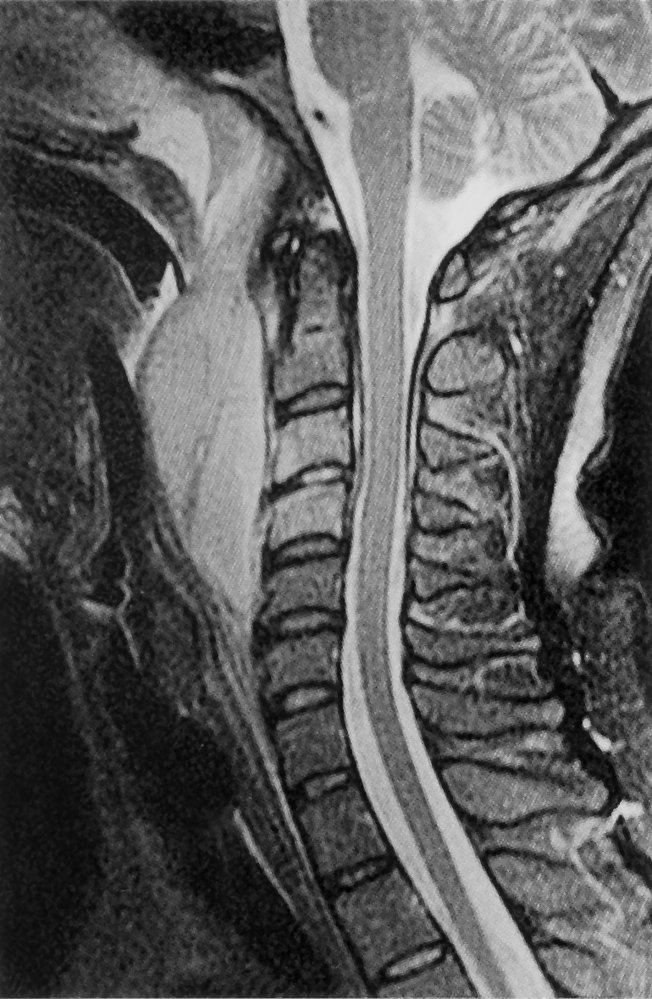 Retropharyngeal abscess with spondylodiscitis and osteomyelitis