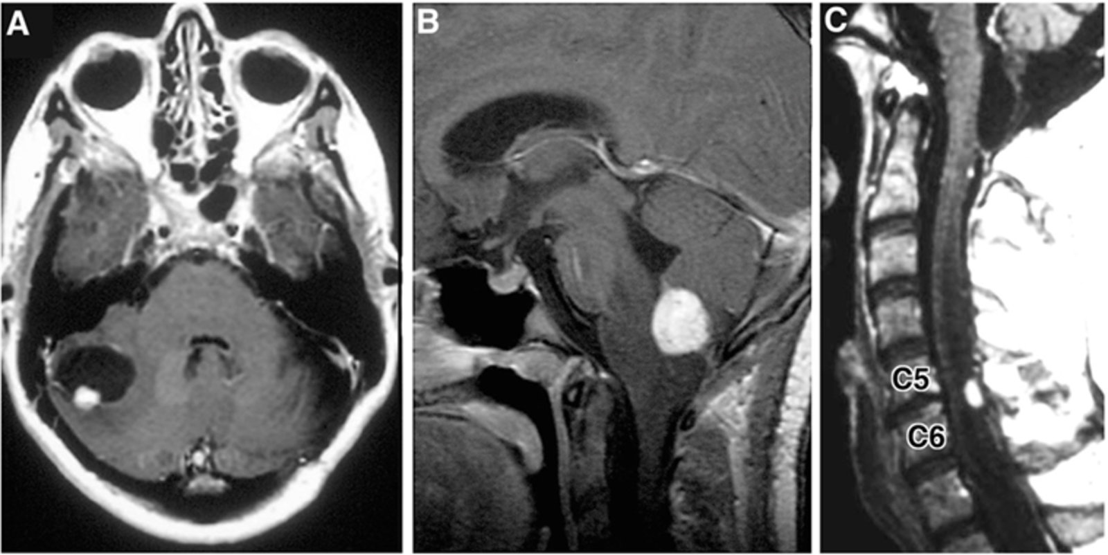 Hemangioblastomas of the central nervous system in Von-Hippel-Lindau syndrome