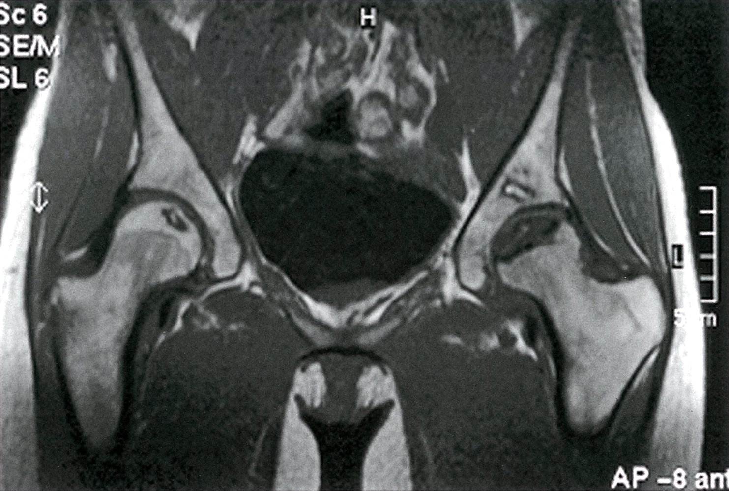 Bilateral osteonecrosis of the femoral head