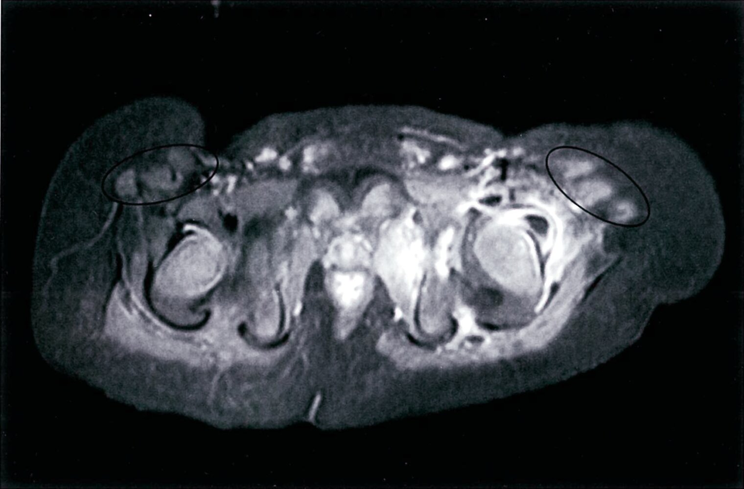 Left hip joint effusion