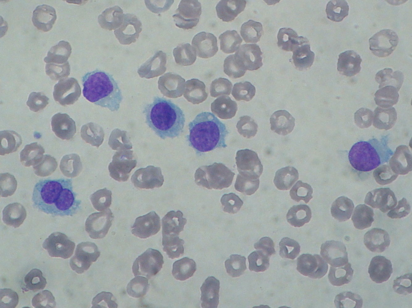 Hairy cell leukemia