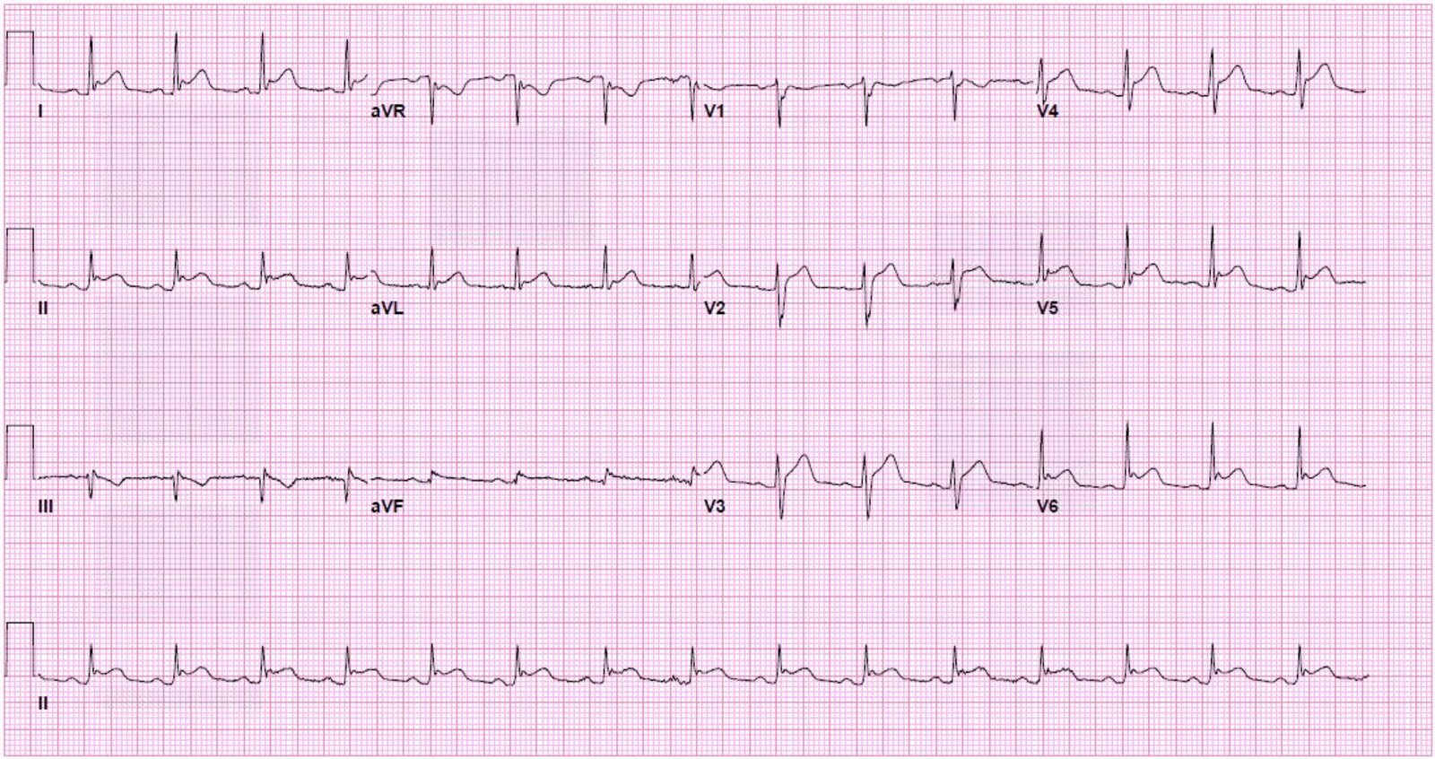 Acute pericarditis