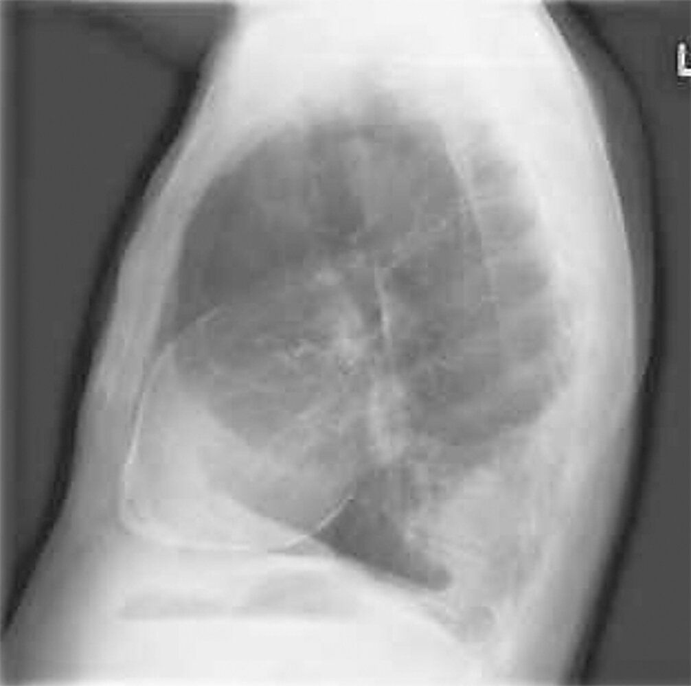 Calcific pericarditis