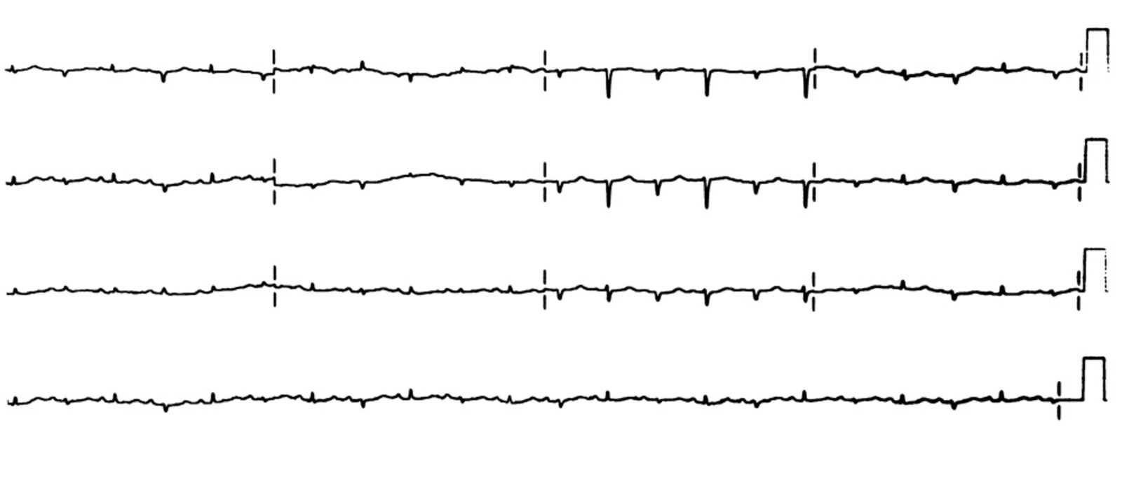 Electrical alternans
