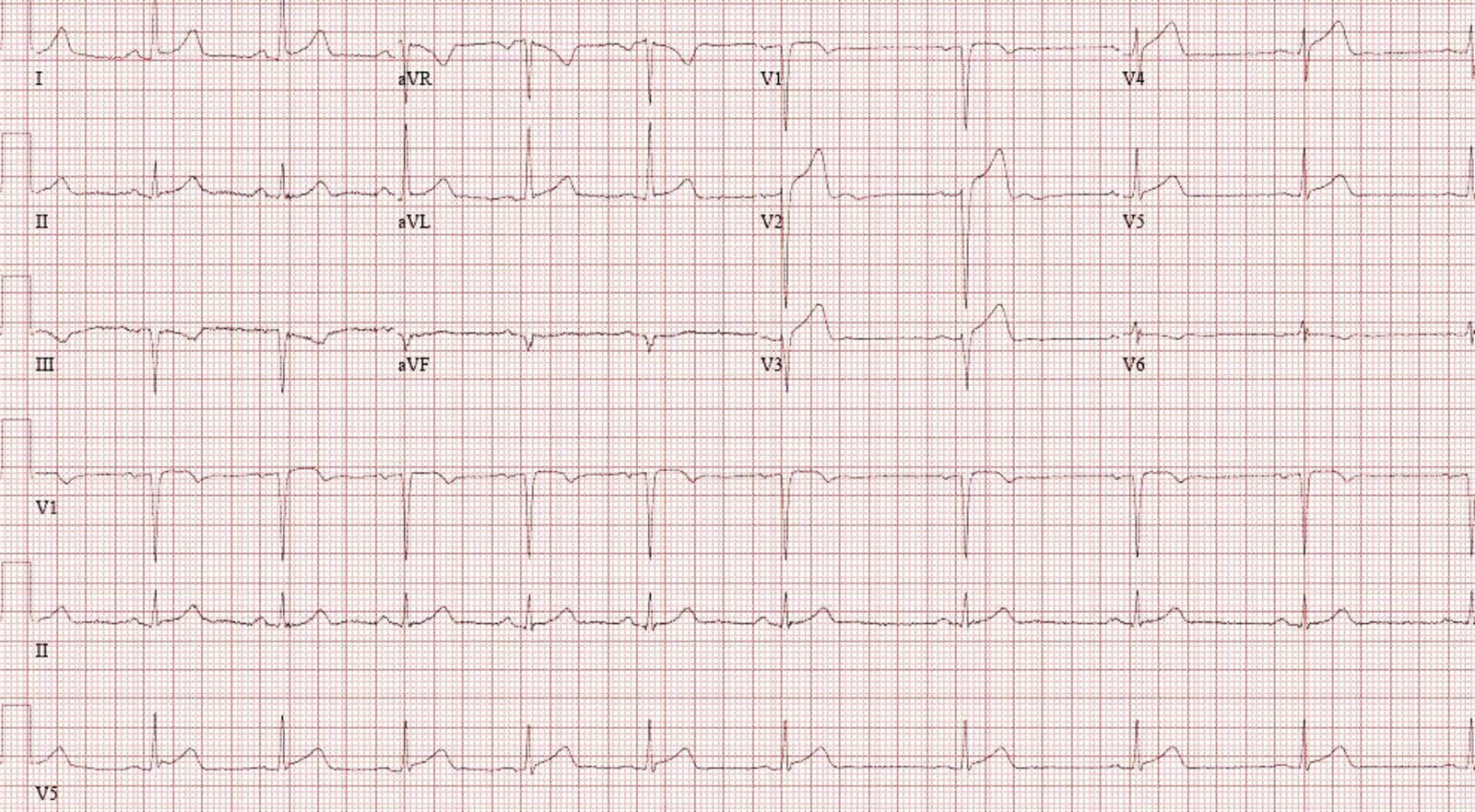 STEMI