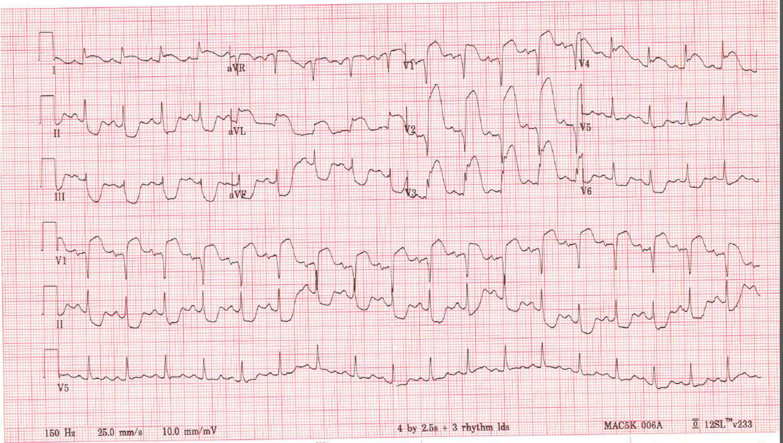 Extensive anterolateral STEMI with septal involvement and reciprocal inferior changes