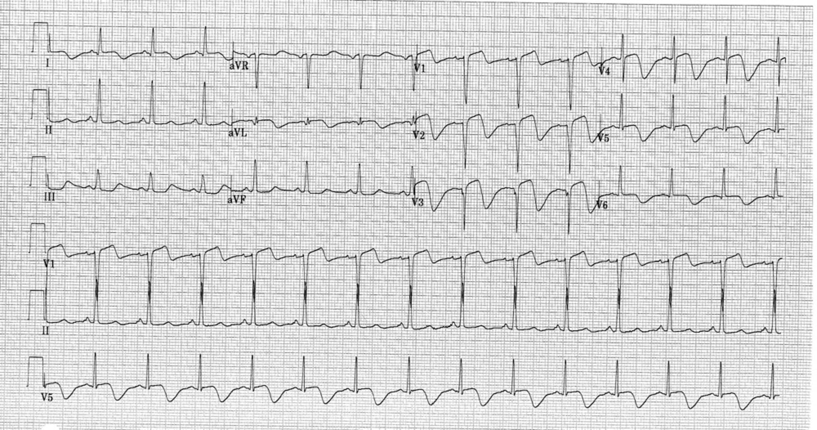 STEMI