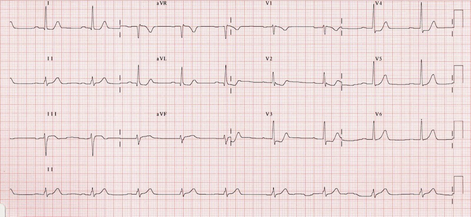 Inferior myocardial infarction