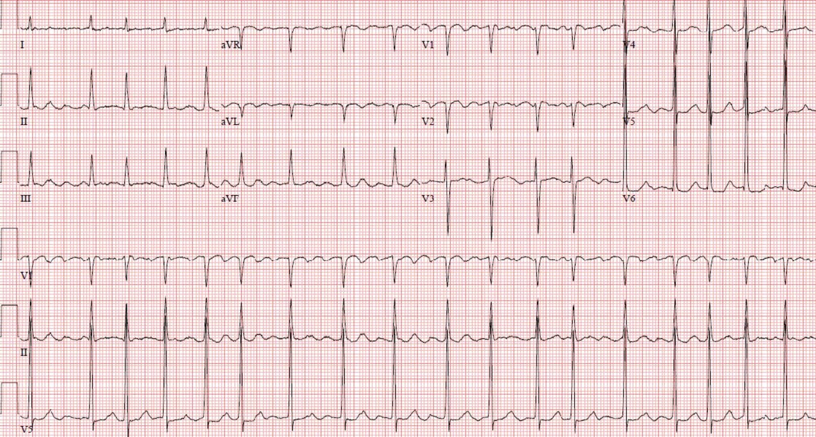 Atrial fibrillation