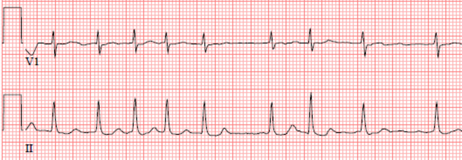 Atrial fibrillation in mitral stenosis