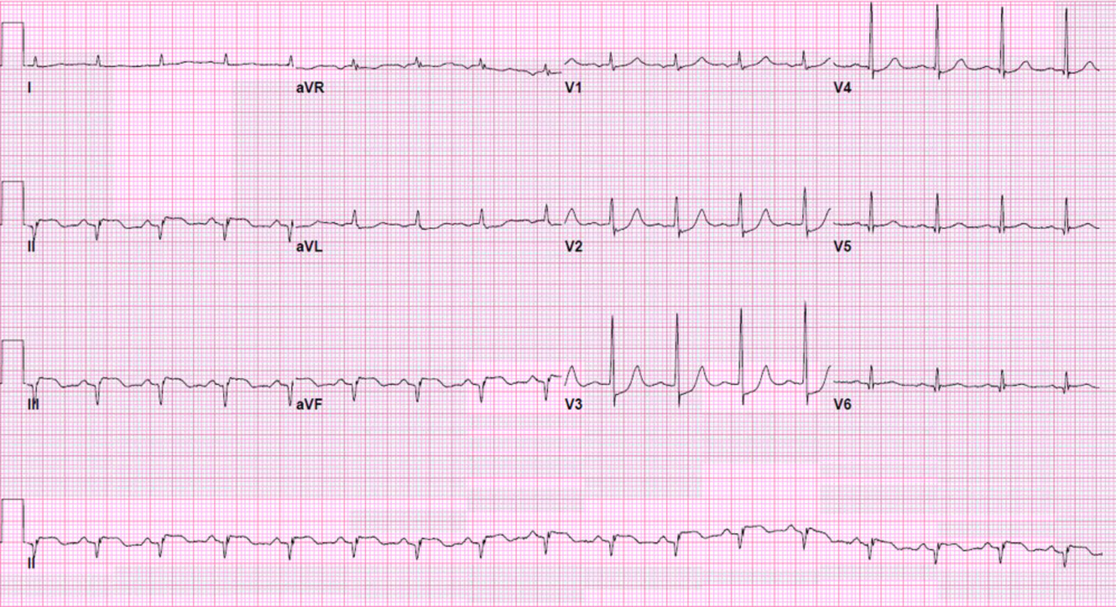 Inferior myocardial infarction