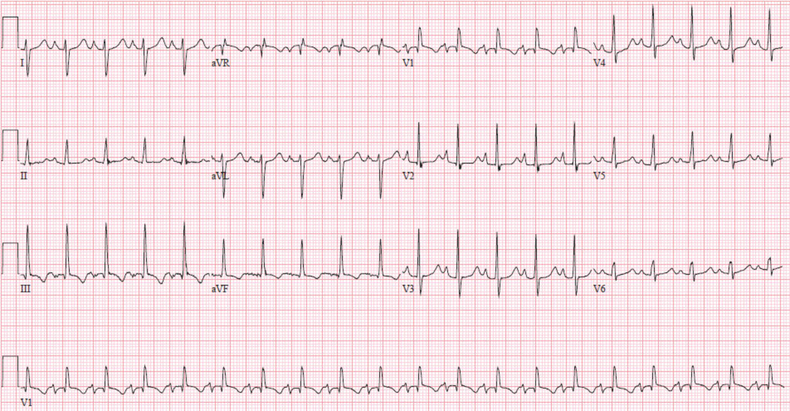 Decompensated right heart failure