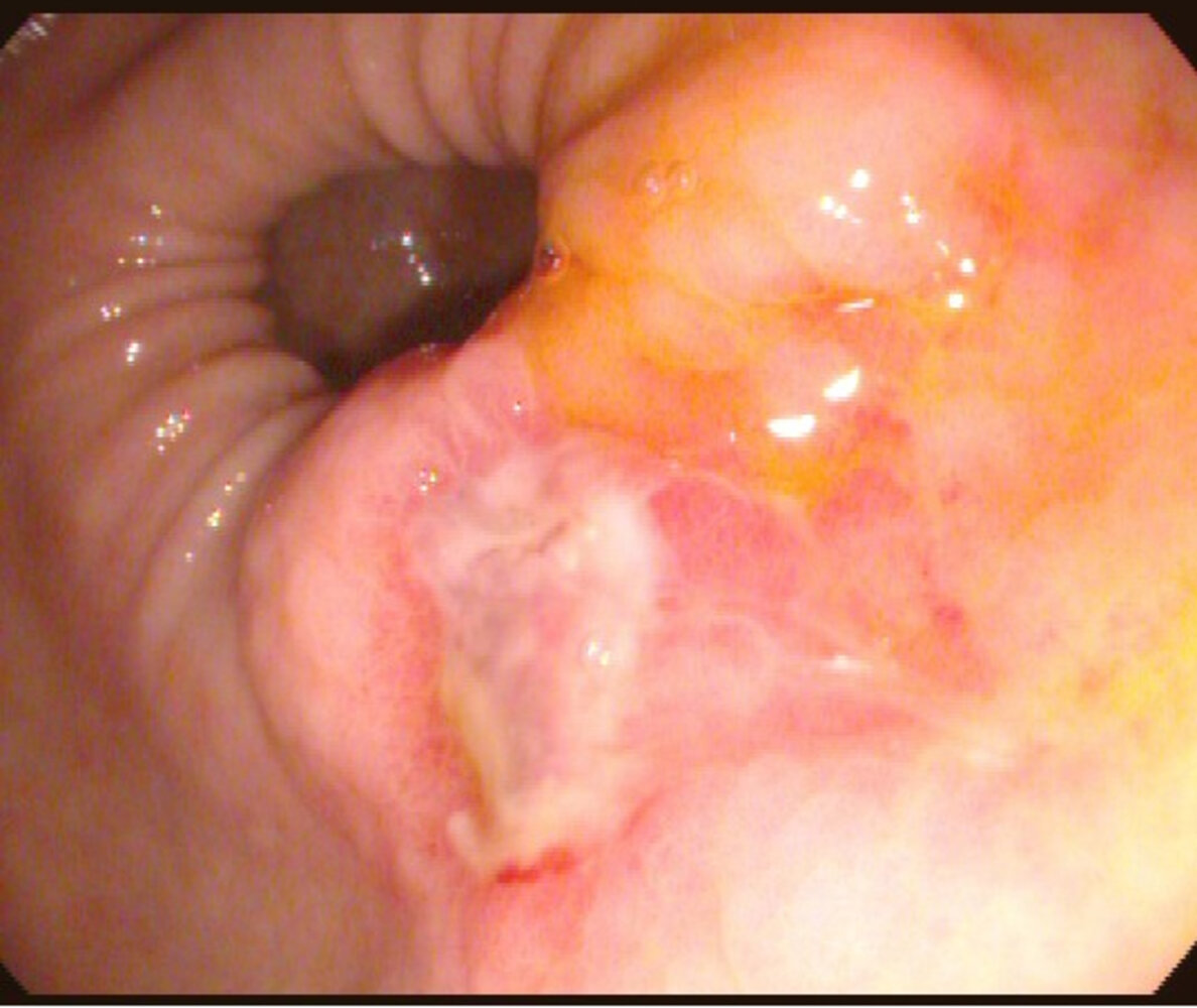 Gastric ulcer