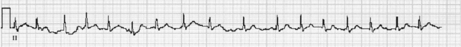 Atrial fibrillation