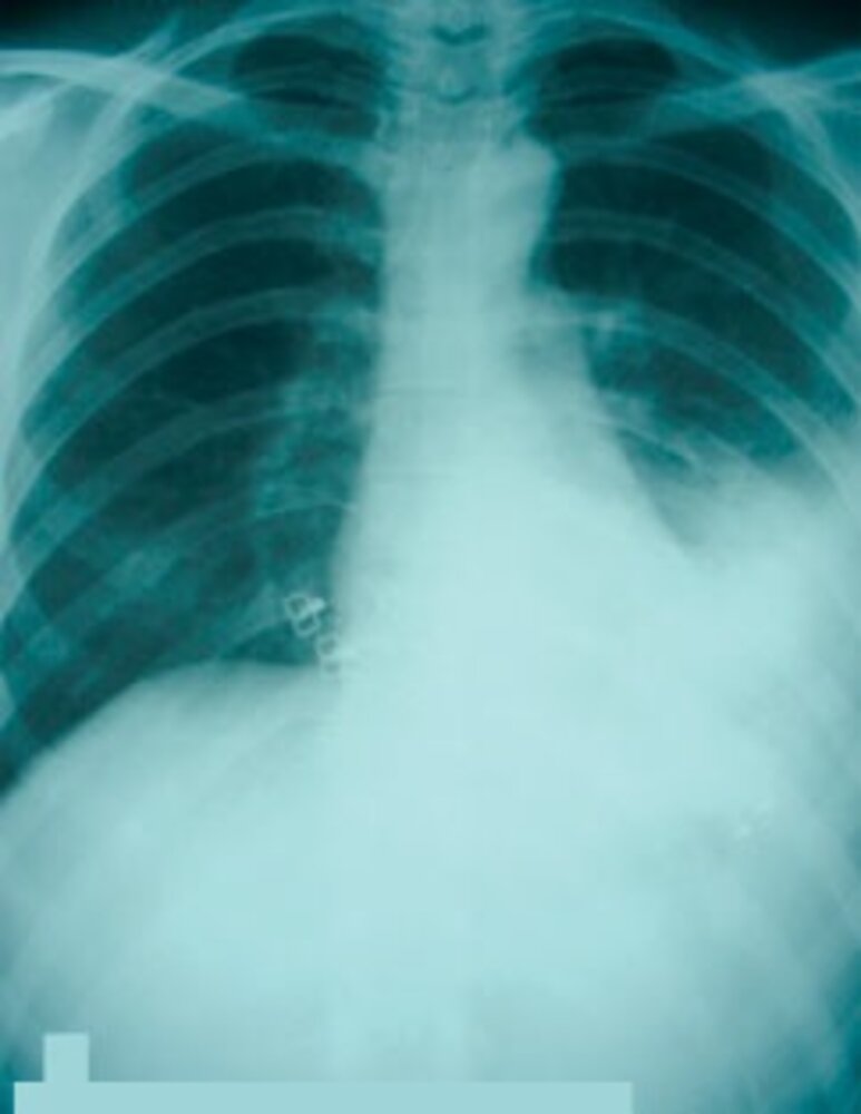 Pneumonia