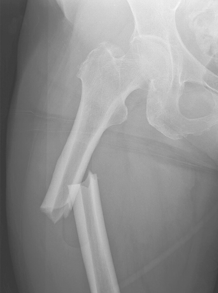 Chalkstick fracture