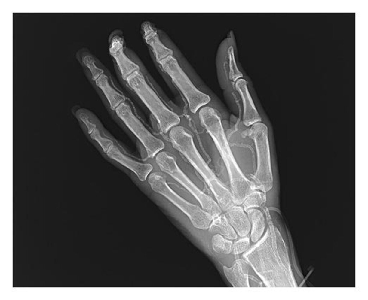 Calciphylaxis